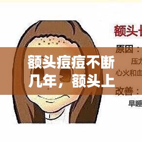 额头痘痘不断几年，额头上长痘痘好几年是什么原因引起的 