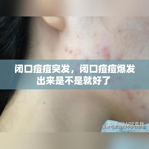 闭口痘痘突发，闭口痘痘爆发出来是不是就好了 