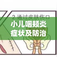 小儿咽颊炎症状及防治，百度权威解答！